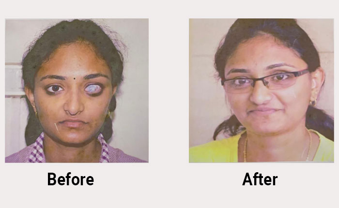 occuloplasty prasad netralaya- occuloplasty