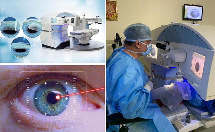 relex-smile ReLEx SMILE